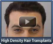 high density Artas hair transplant