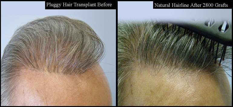 Hair Transplant Repair