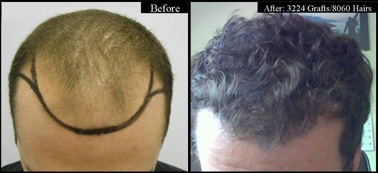 3300 Grafts Before & After