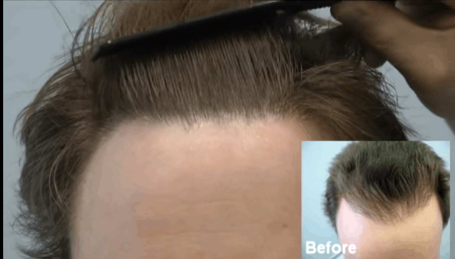 After Hair Transplant Repair