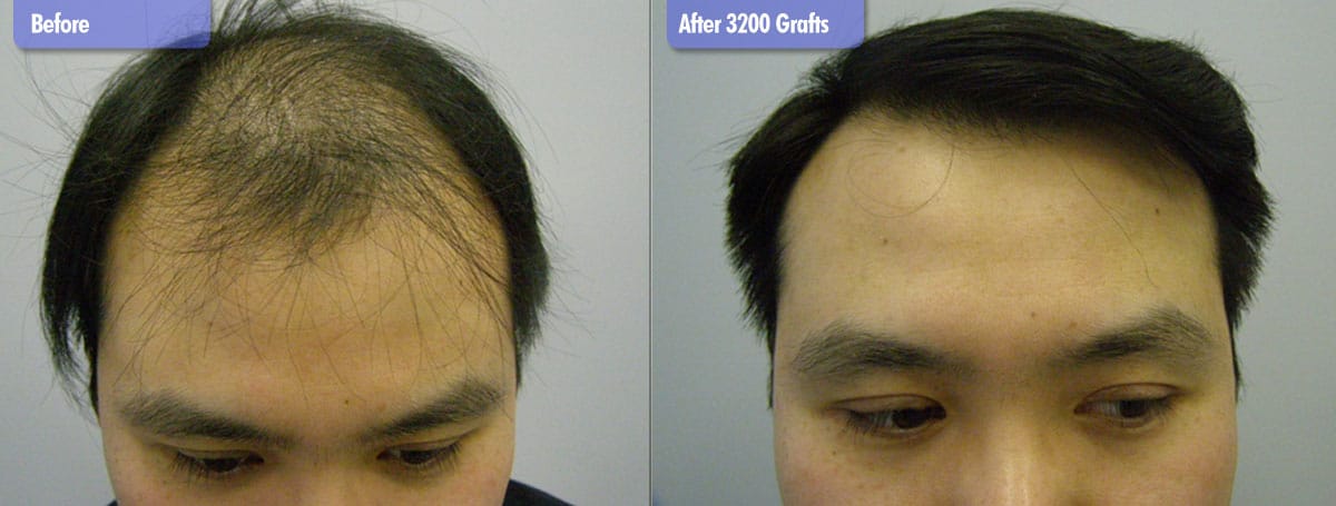 Hair Transplant Before & After Video & Photo Gallery ...