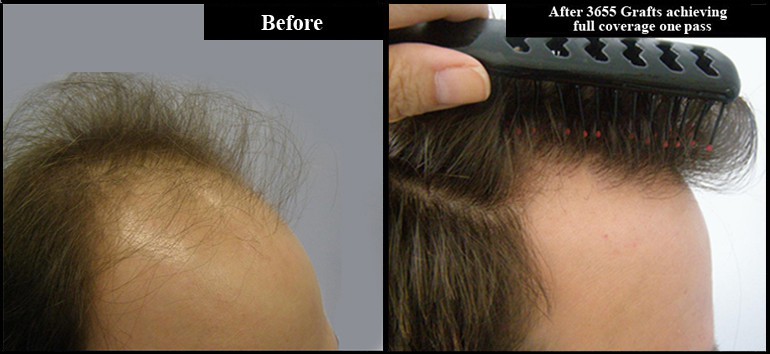 3665 Grafts Before & After Hair Line Right Side