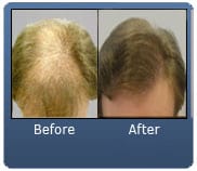 Diffuse Thinning 3000 FUE Grafts