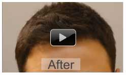 2000 FUE Hairline hair Transplant – Hairline (High Density)