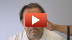 Hair Transplant Review Video - Norwood 7 patient