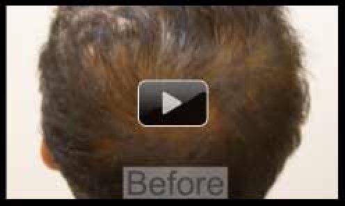 2000 FUE Crown Hair Transplant – Crown Hair Loss