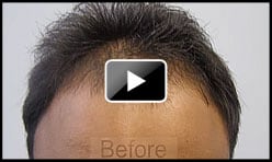 Indian Male FUT 3500 Graft Hair Transplant - Norwood 3